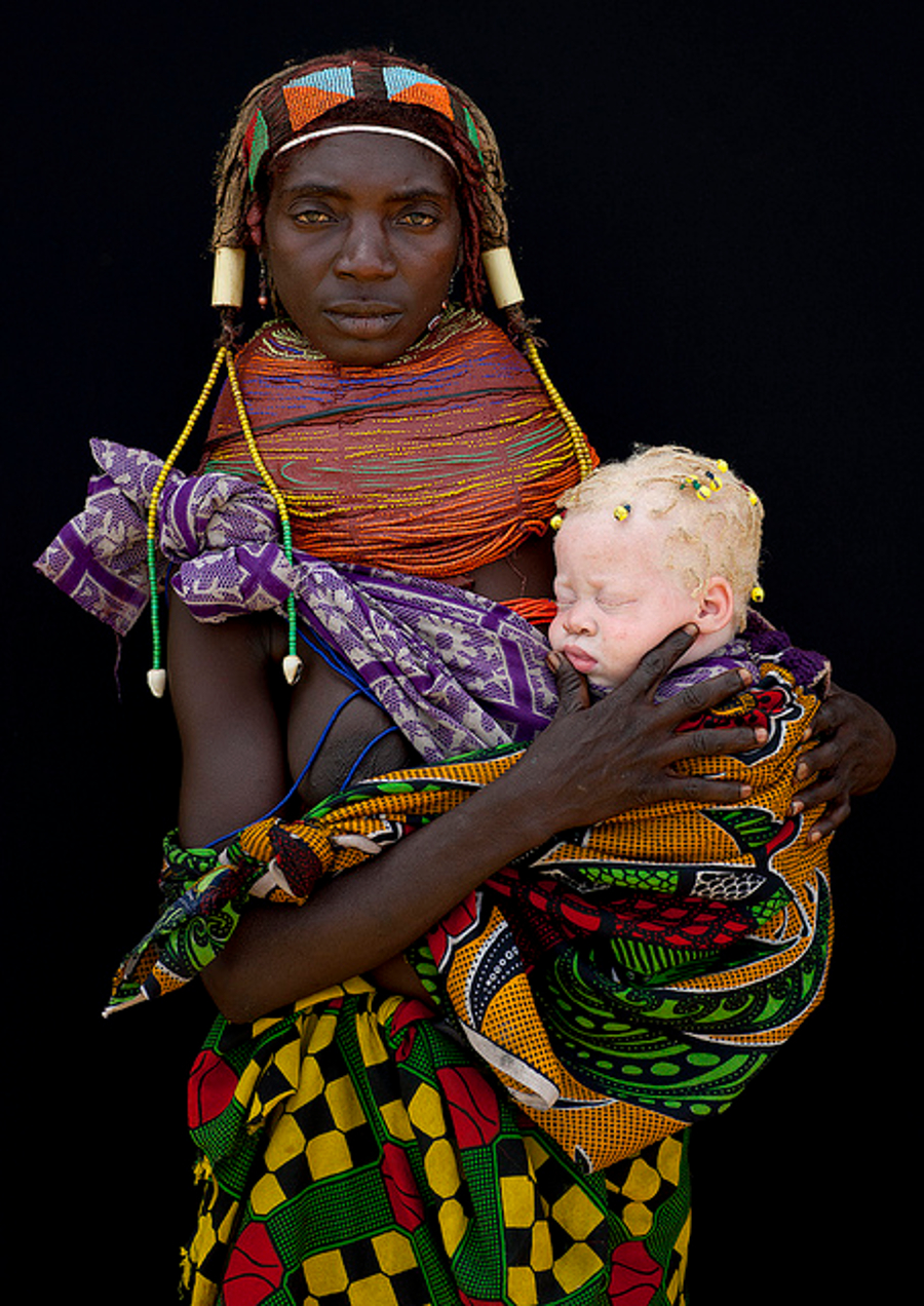 caucasian albino eyes